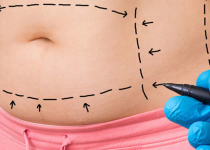 Indications médicales d’une liposuccion